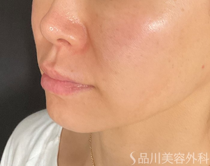 症例NO.75356のBEFORE写真