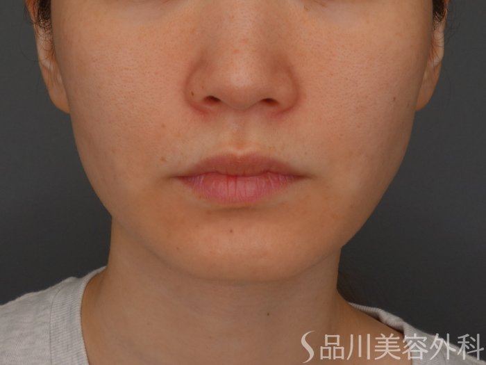症例NO.75102のBEFORE写真
