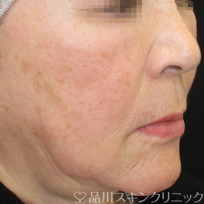 症例NO.74692のBEFORE写真