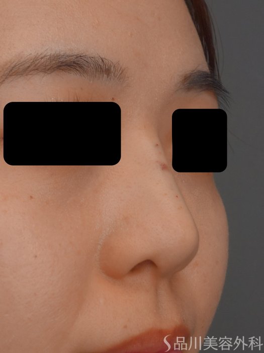 症例NO.73467のAFTER写真