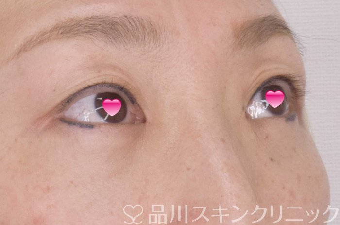 症例NO.69526のAFTER写真