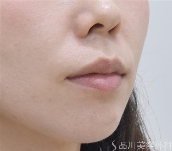 症例NO.44114のBEFORE写真
