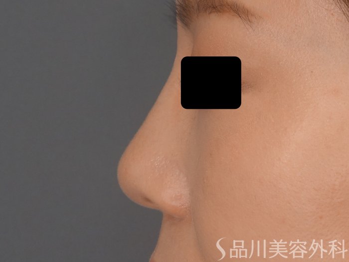 症例NO.63198のBEFORE写真