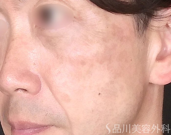 症例NO.70264のBEFORE写真