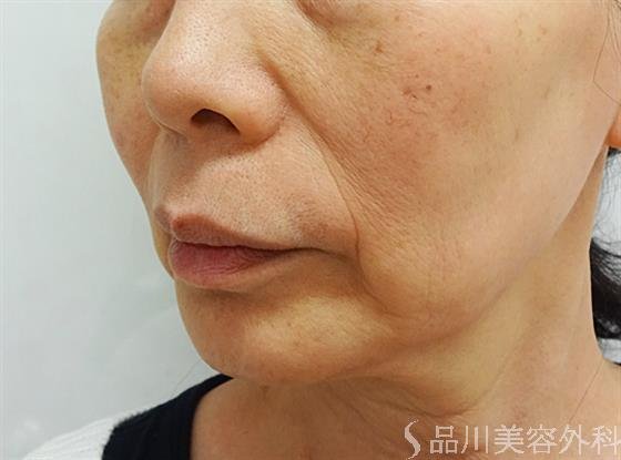 症例NO.44528のBEFORE写真