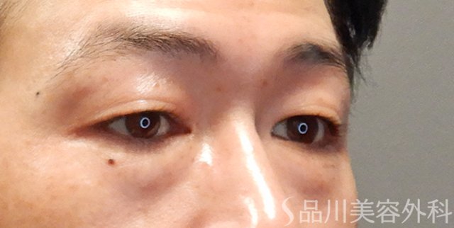 症例NO.74435のBEFORE写真