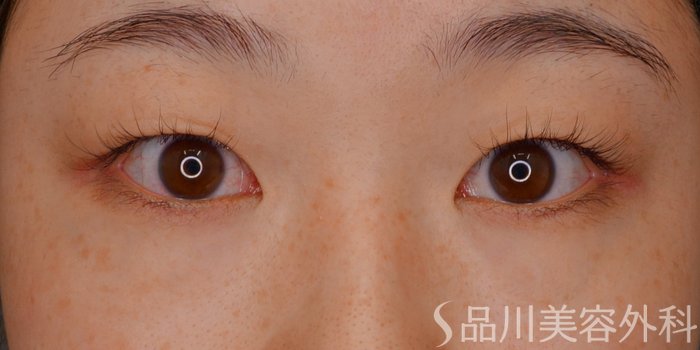 症例NO.73506のBEFORE写真