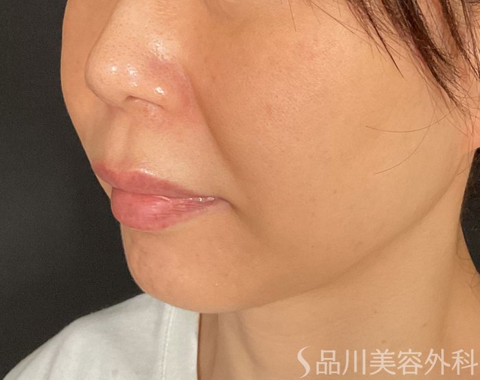症例NO.75209のBEFORE写真