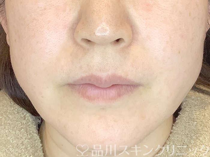 症例NO.65174のAFTER写真
