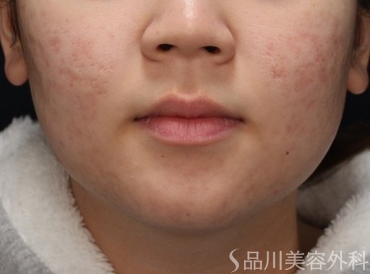 症例NO.73292のAFTER写真