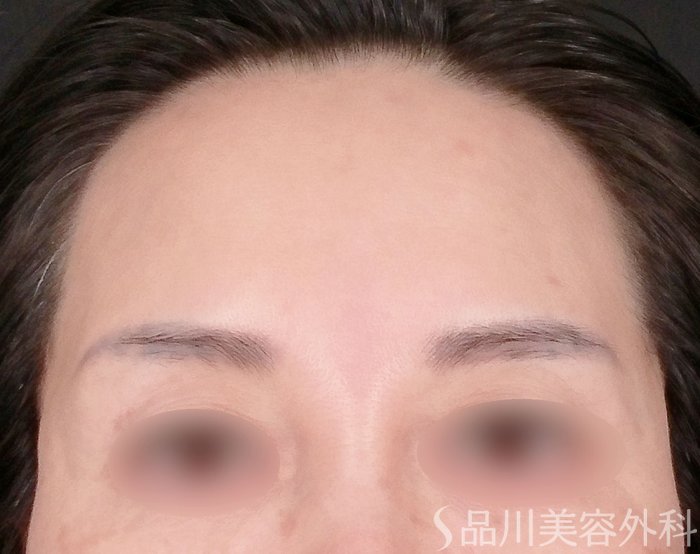 症例NO.69685のBEFORE写真
