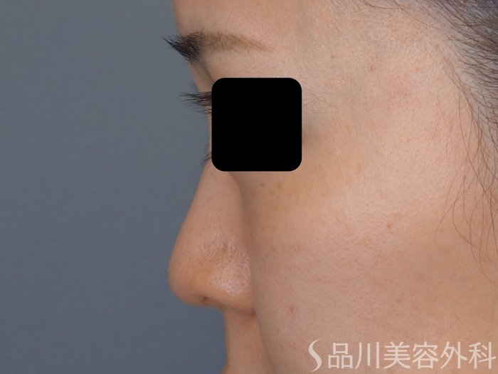 症例NO.72466のBEFORE写真