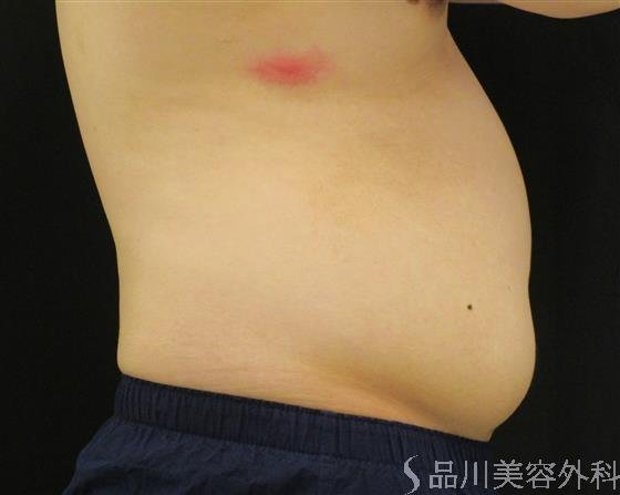 症例NO.51291のBEFORE写真