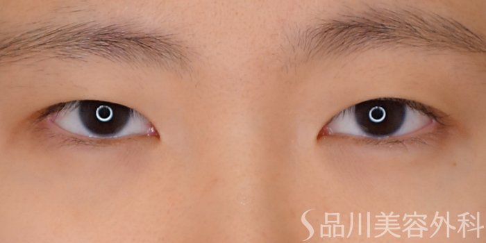 症例NO.70523のBEFORE写真
