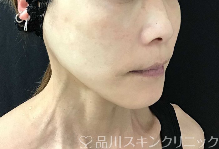 症例NO.71108のAFTER写真