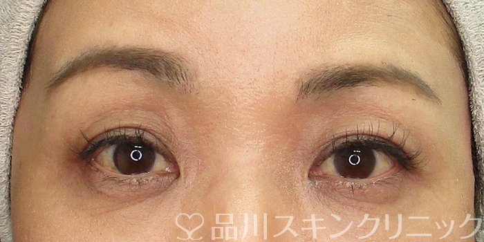 症例NO.69692のBEFORE写真