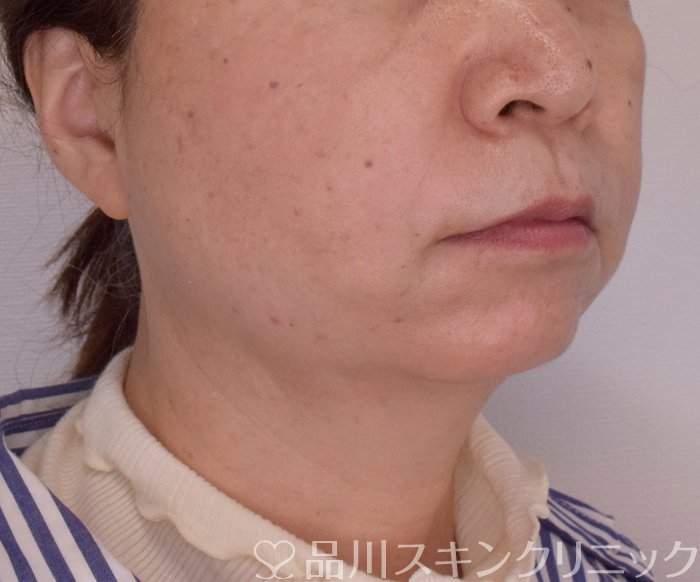 症例NO.69420のAFTER写真