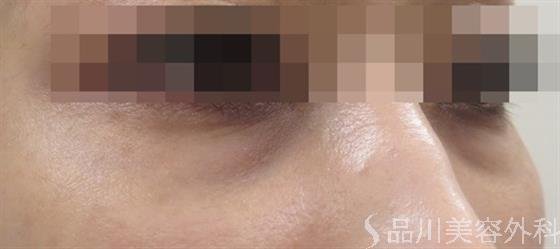 症例NO.36526のBEFORE写真