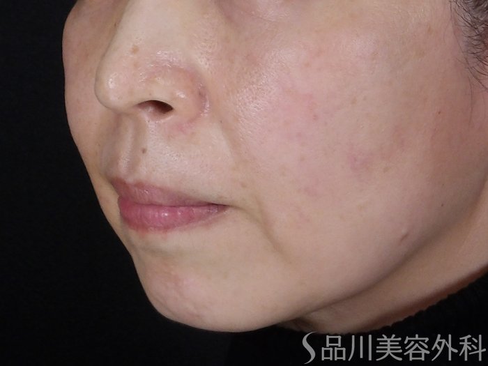 症例NO.69833のBEFORE写真