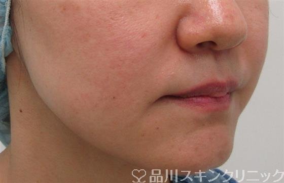 症例NO.35438のBEFORE写真