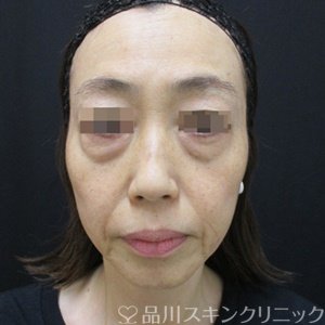 症例NO.71869のBEFORE写真