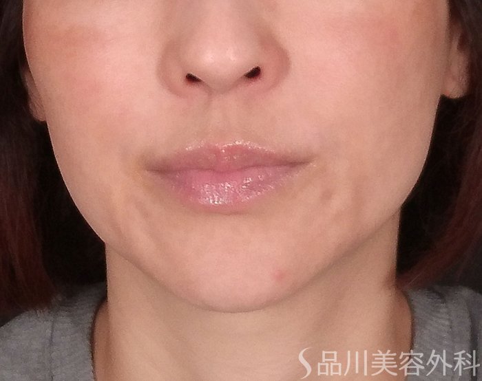 症例NO.70807のBEFORE写真