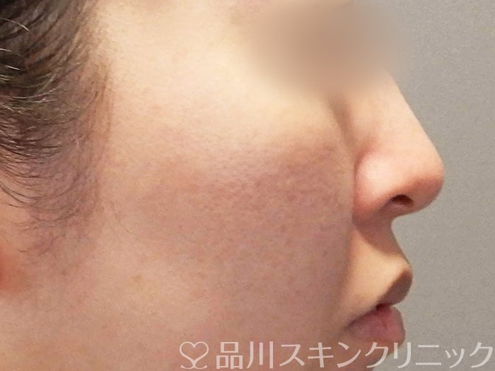 症例NO.65543のBEFORE写真