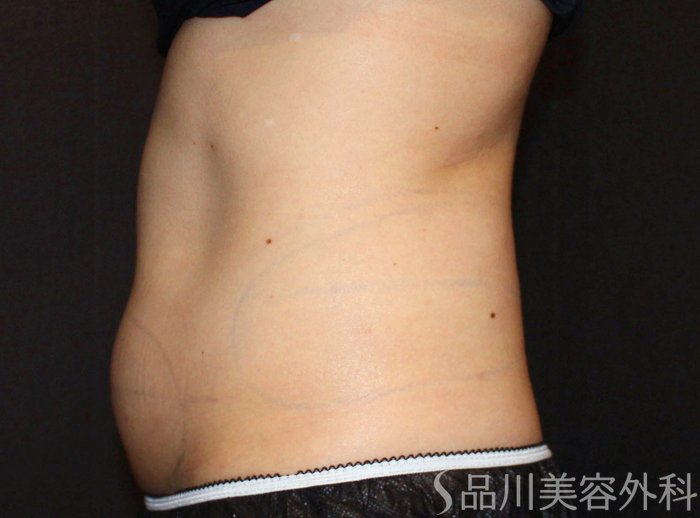 症例NO.74707のBEFORE写真