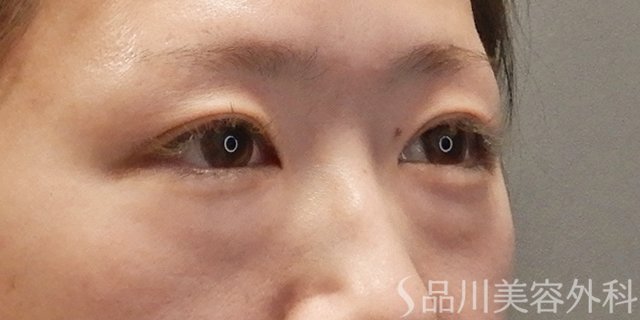 症例NO.74060のBEFORE写真