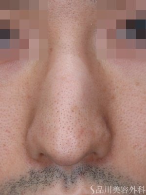 症例NO.65506のBEFORE写真