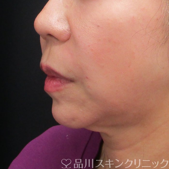 症例NO.72773のAFTER写真