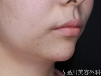 症例NO.65118のAFTER写真