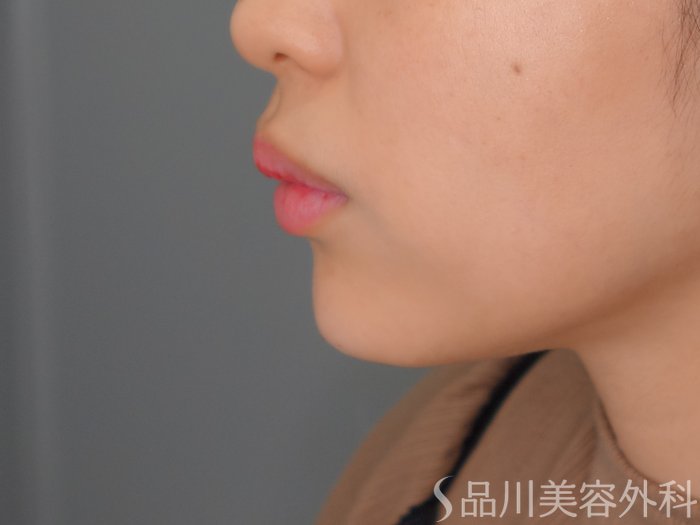 症例NO.69950のAFTER写真