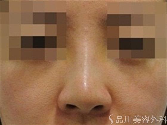 症例NO.19344のAFTER写真