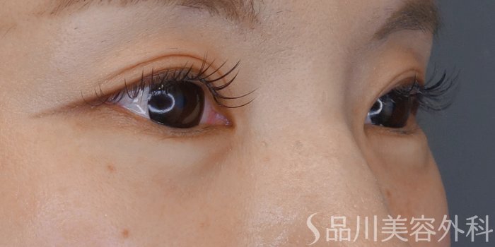 症例NO.69620のAFTER写真