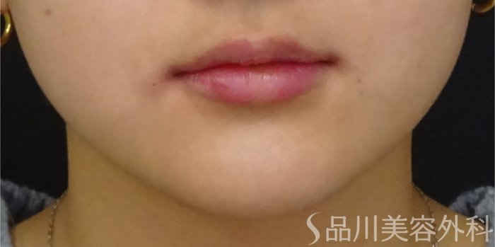 症例NO.69043のAFTER写真