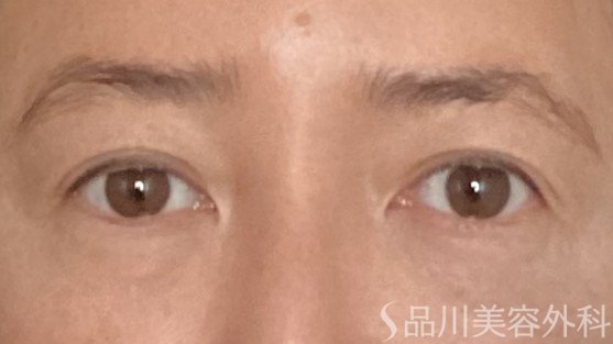 症例NO.65007のBEFORE写真