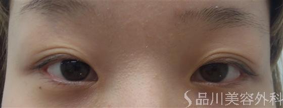 症例NO.13154のBEFORE写真