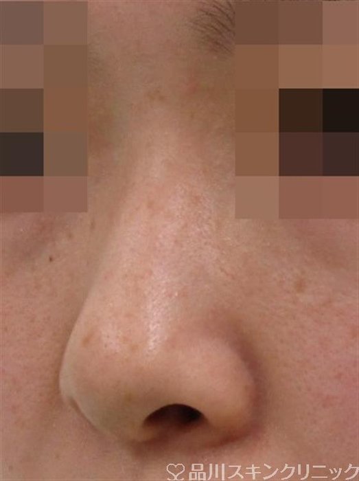 症例NO.38833のBEFORE写真