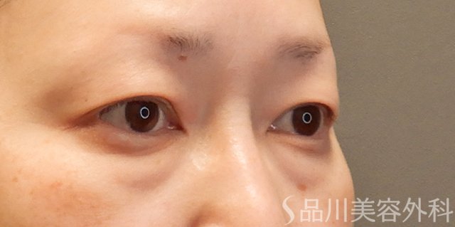 症例NO.74246のBEFORE写真