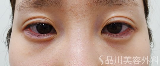 症例NO.70161のAFTER写真