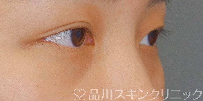 症例NO.72572のBEFORE写真