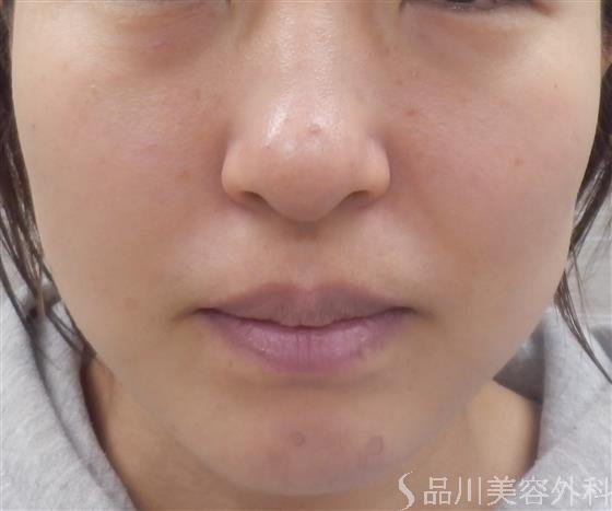 症例NO.39301のAFTER写真