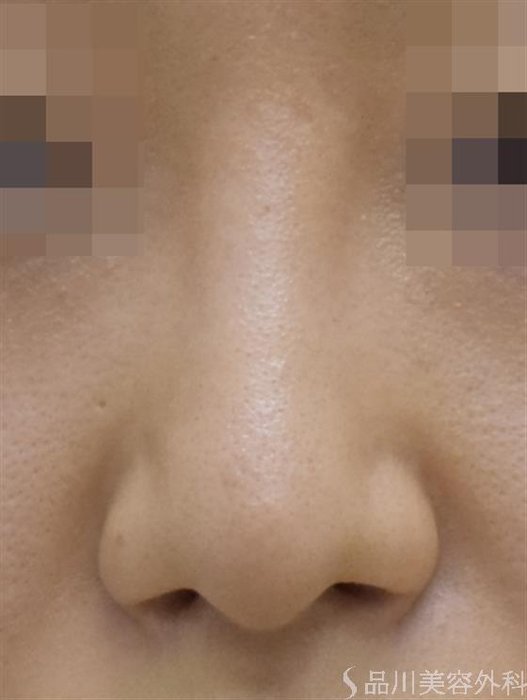 症例NO.52915のBEFORE写真