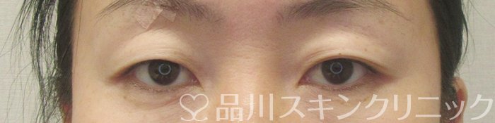 症例NO.70940のBEFORE写真