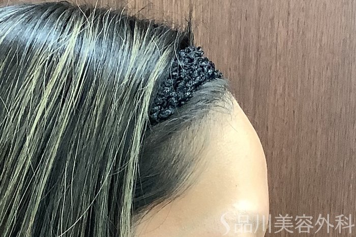 症例NO.67836のBEFORE写真