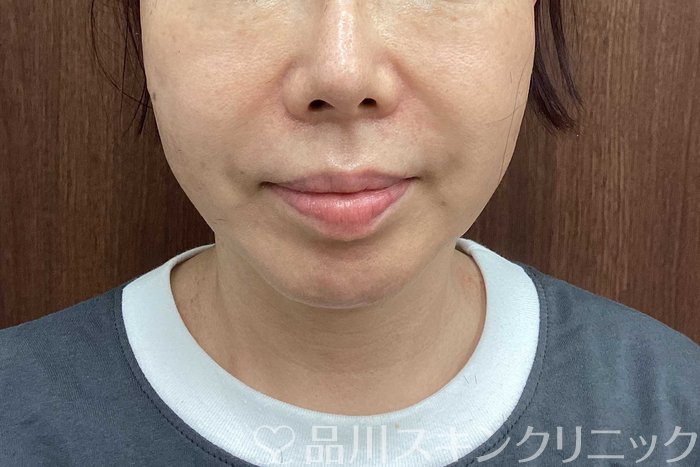 症例NO.71291のAFTER写真