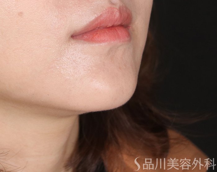 症例NO.72266のBEFORE写真