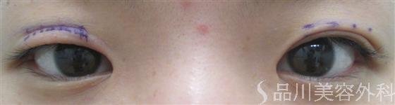 症例NO.16791のBEFORE写真