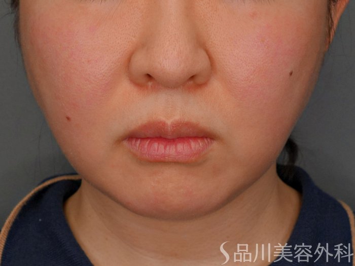 症例NO.73744のBEFORE写真